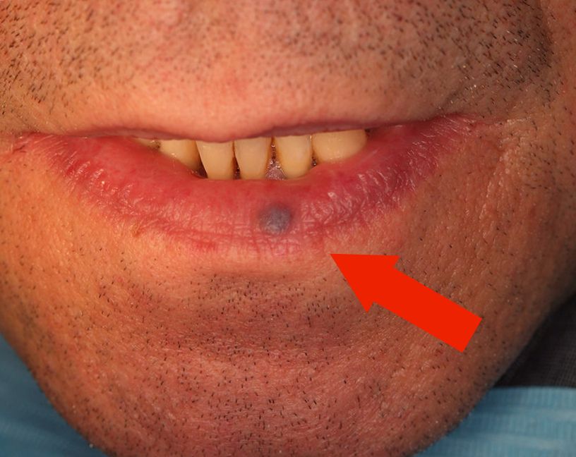 The value of moles over the lip
