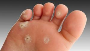 Callosités sèches sur l'orteil : traitement
