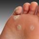 Dry callus on the toe: treatment